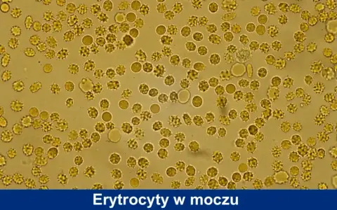 Mikroskopowy obraz erytrocytów w moczu psa. Widoczne liczne, okrągłe komórki, niektóre o postrzępionych brzegach, co może wskazywać na normę.