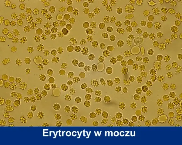 Mikroskopowy obraz erytrocytów w moczu psa. Widoczne liczne, okrągłe komórki, niektóre o postrzępionych brzegach, co może wskazywać na normę.