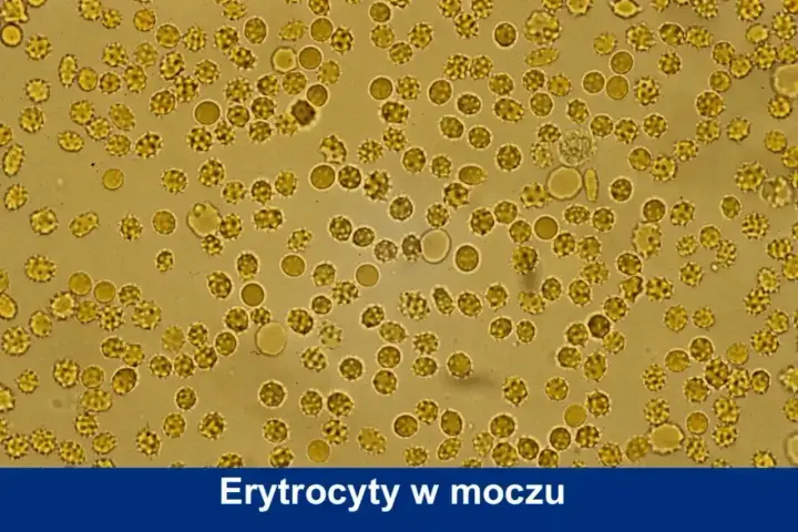 Mikroskopowy obraz erytrocytów w moczu psa. Widoczne liczne, okrągłe komórki, niektóre o postrzępionych brzegach, co może wskazywać na normę.
