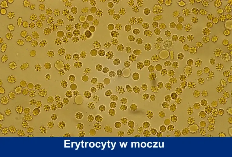 Mikroskopowy obraz erytrocytów w moczu psa. Widoczne liczne, okrągłe komórki, niektóre o postrzępionych brzegach, co może wskazywać na normę.